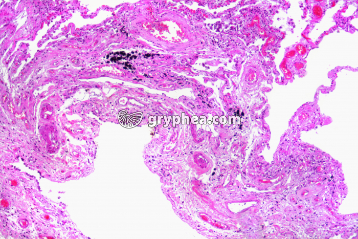 Poumon fumeur x25 - gryphea.org